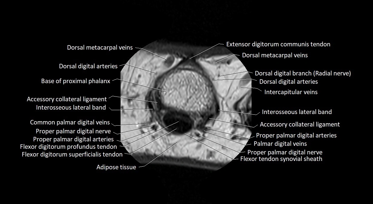 Finger anatomy axial cross sectional 3T image image 21.webp